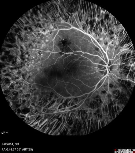 Proliferative Diabetic Retinopathy with Panretinal Photocoagulation
57 year old female Type 1 DM with prior laser about 10 years ago in Chicago.
HTN, Thyroid cancer and removal, Cardiovascular disease
Meds: ASA 325 mg /day, etc
Recent new floaters in the right eye:

VA 20/50 OD, 20/40 OS
