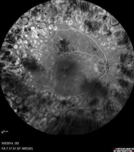 Proliferative Diabetic Retinopathy with Panretinal Photocoagulation
57 year old female Type 1 DM with prior laser about 10 years ago in Chicago.
HTN, Thyroid cancer and removal, Cardiovascular disease
Meds: ASA 325 mg /day, etc
Recent new floaters in the right eye:

VA 20/50 OD, 20/40 OS
