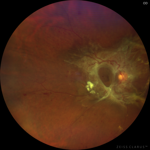 Severe diabetic tractional retinal detachment one year following diagnosis of type II Diabetes Mellitus
44 year old man The vision in the left eye started to decline about 4 days ago.Â  Prior to that the left eye was the better eye.Â  He was diagnosed with diabetes a year ago.Â  
VA OD: Dcc20/50-1 OS: Dcc20/125-2, TP: OD:12 OS:13

Following two surgeries in each eye, silicone oil remaining forever, monthly anti-VEGF for severe DME - BCVA OU 20/200 at 3 years
