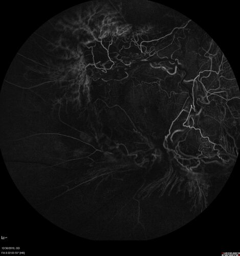 Severe diabetic tractional retinal detachment one year following diagnosis of type II Diabetes Mellitus
44 year old man The vision in the left eye started to decline about 4 days ago.Â  Prior to that the left eye was the better eye.Â  He was diagnosed with diabetes a year ago.Â  
VA OD: Dcc20/50-1 OS: Dcc20/125-2, TP: OD:12 OS:13

Following two surgeries in each eye, silicone oil remaining forever, monthly anti-VEGF for severe DME - BCVA OU 20/200 at 3 years
