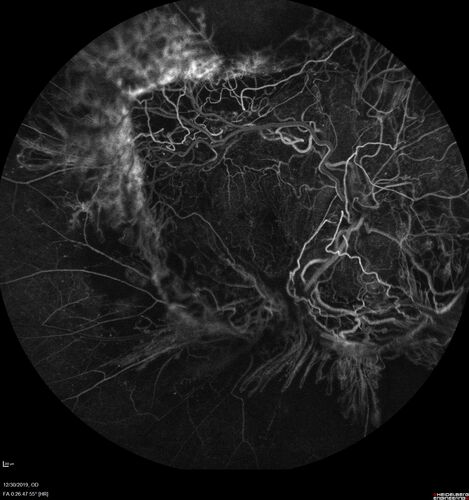 Severe diabetic tractional retinal detachment one year following diagnosis of type II Diabetes Mellitus
44 year old man The vision in the left eye started to decline about 4 days ago.Â  Prior to that the left eye was the better eye.Â  He was diagnosed with diabetes a year ago.Â  
VA OD: Dcc20/50-1 OS: Dcc20/125-2, TP: OD:12 OS:13

Following two surgeries in each eye, silicone oil remaining forever, monthly anti-VEGF for severe DME - BCVA OU 20/200 at 3 years
