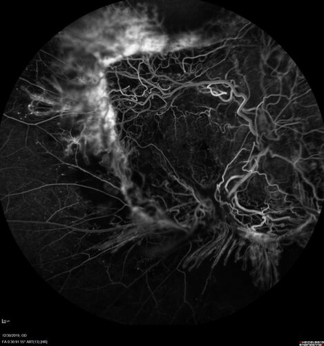 Severe diabetic tractional retinal detachment one year following diagnosis of type II Diabetes Mellitus
44 year old man The vision in the left eye started to decline about 4 days ago.Â  Prior to that the left eye was the better eye.Â  He was diagnosed with diabetes a year ago.Â  
VA OD: Dcc20/50-1 OS: Dcc20/125-2, TP: OD:12 OS:13

Following two surgeries in each eye, silicone oil remaining forever, monthly anti-VEGF for severe DME - BCVA OU 20/200 at 3 years
