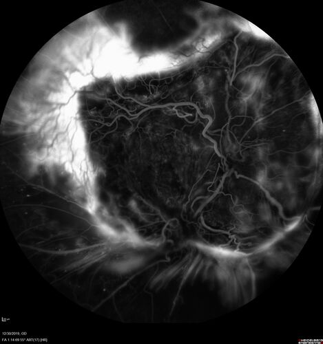 Severe diabetic tractional retinal detachment one year following diagnosis of type II Diabetes Mellitus
44 year old man The vision in the left eye started to decline about 4 days ago.Â  Prior to that the left eye was the better eye.Â  He was diagnosed with diabetes a year ago.Â  
VA OD: Dcc20/50-1 OS: Dcc20/125-2, TP: OD:12 OS:13

Following two surgeries in each eye, silicone oil remaining forever, monthly anti-VEGF for severe DME - BCVA OU 20/200 at 3 years
