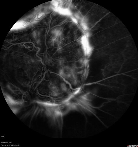 Severe diabetic tractional retinal detachment one year following diagnosis of type II Diabetes Mellitus
44 year old man The vision in the left eye started to decline about 4 days ago.Â  Prior to that the left eye was the better eye.Â  He was diagnosed with diabetes a year ago.Â  
VA OD: Dcc20/50-1 OS: Dcc20/125-2, TP: OD:12 OS:13

Following two surgeries in each eye, silicone oil remaining forever, monthly anti-VEGF for severe DME - BCVA OU 20/200 at 3 years
