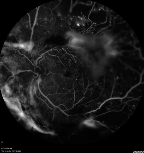 Severe diabetic tractional retinal detachment one year following diagnosis of type II Diabetes Mellitus
44 year old man The vision in the left eye started to decline about 4 days ago.Â  Prior to that the left eye was the better eye.Â  He was diagnosed with diabetes a year ago.Â  
VA OD: Dcc20/50-1 OS: Dcc20/125-2, TP: OD:12 OS:13

Following two surgeries in each eye, silicone oil remaining forever, monthly anti-VEGF for severe DME - BCVA OU 20/200 at 3 years
