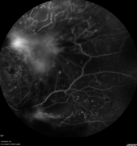 Severe diabetic tractional retinal detachment one year following diagnosis of type II Diabetes Mellitus
44 year old man The vision in the left eye started to decline about 4 days ago.Â  Prior to that the left eye was the better eye.Â  He was diagnosed with diabetes a year ago.Â  
VA OD: Dcc20/50-1 OS: Dcc20/125-2, TP: OD:12 OS:13

Following two surgeries in each eye, silicone oil remaining forever, monthly anti-VEGF for severe DME - BCVA OU 20/200 at 3 years
