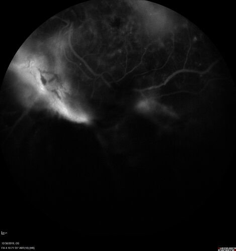 Severe diabetic tractional retinal detachment one year following diagnosis of type II Diabetes Mellitus
44 year old man The vision in the left eye started to decline about 4 days ago.Â  Prior to that the left eye was the better eye.Â  He was diagnosed with diabetes a year ago.Â  
VA OD: Dcc20/50-1 OS: Dcc20/125-2, TP: OD:12 OS:13

Following two surgeries in each eye, silicone oil remaining forever, monthly anti-VEGF for severe DME - BCVA OU 20/200 at 3 years
