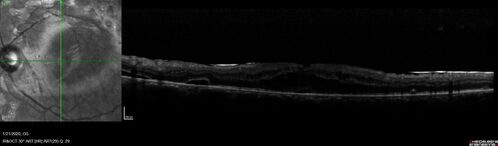 Severe diabetic tractional retinal detachment one year following diagnosis of type II Diabetes Mellitus
44 year old man The vision in the left eye started to decline about 4 days ago.Â  Prior to that the left eye was the better eye.Â  He was diagnosed with diabetes a year ago.Â  
VA OD: Dcc20/50-1 OS: Dcc20/125-2, TP: OD:12 OS:13

Following two surgeries in each eye, silicone oil remaining forever, monthly anti-VEGF for severe DME - BCVA OU 20/200 at 3 years
