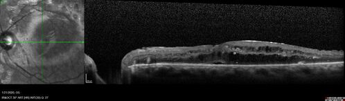 Severe diabetic tractional retinal detachment one year following diagnosis of type II Diabetes Mellitus
44 year old man The vision in the left eye started to decline about 4 days ago.Â  Prior to that the left eye was the better eye.Â  He was diagnosed with diabetes a year ago.Â  
VA OD: Dcc20/50-1 OS: Dcc20/125-2, TP: OD:12 OS:13

Following two surgeries in each eye, silicone oil remaining forever, monthly anti-VEGF for severe DME - BCVA OU 20/200 at 3 years
