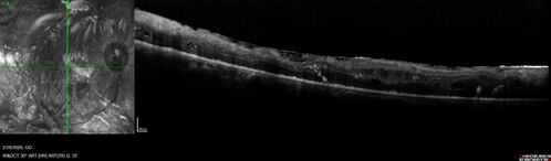 Severe diabetic tractional retinal detachment one year following diagnosis of type II Diabetes Mellitus
44 year old man The vision in the left eye started to decline about 4 days ago.Â  Prior to that the left eye was the better eye.Â  He was diagnosed with diabetes a year ago.Â  
VA OD: Dcc20/50-1 OS: Dcc20/125-2, TP: OD:12 OS:13

Following two surgeries in each eye, silicone oil remaining forever, monthly anti-VEGF for severe DME - BCVA OU 20/200 at 3 years
