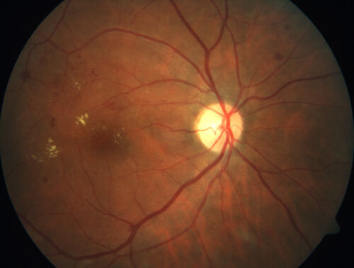 Proliferative Diabetic Retinopathy and vitreous hemorrhage left eye
44 year old man with type II diabetes for 14 years and no eye examinations in the last 5 years.  VA 20/40 right eye and 20/60 left eye.  Vision loss has been for about a week in the left eye.
