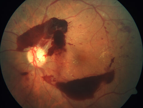 Proliferative Diabetic Retinopathy and vitreous hemorrhage left eye
44 year old man with type II diabetes for 14 years and no eye examinations in the last 5 years.  VA 20/40 right eye and 20/60 left eye.  Vision loss has been for about a week in the left eye.
