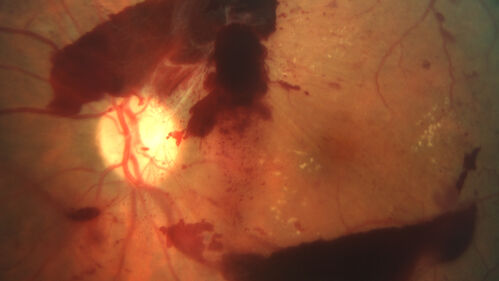 Proliferative Diabetic Retinopathy and vitreous hemorrhage left eye
44 year old man with type II diabetes for 14 years and no eye examinations in the last 5 years.  VA 20/40 right eye and 20/60 left eye.  Vision loss has been for about a week in the left eye.

