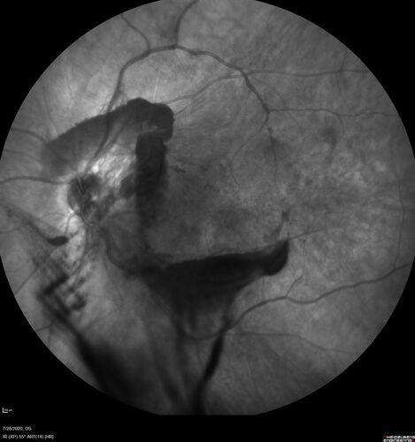 Proliferative Diabetic Retinopathy and vitreous hemorrhage left eye
44 year old man with type II diabetes for 14 years and no eye examinations in the last 5 years.  VA 20/40 right eye and 20/60 left eye.  Vision loss has been for about a week in the left eye.
