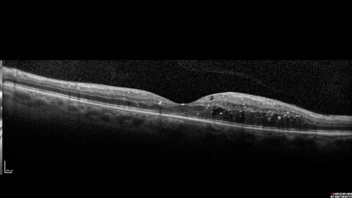Proliferative Diabetic Retinopathy and vitreous hemorrhage left eye
44 year old man with type II diabetes for 14 years and no eye examinations in the last 5 years.  VA 20/40 right eye and 20/60 left eye.  Vision loss has been for about a week in the left eye.
