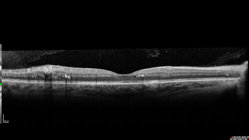 Proliferative Diabetic Retinopathy and vitreous hemorrhage left eye
44 year old man with type II diabetes for 14 years and no eye examinations in the last 5 years.  VA 20/40 right eye and 20/60 left eye.  Vision loss has been for about a week in the left eye.
