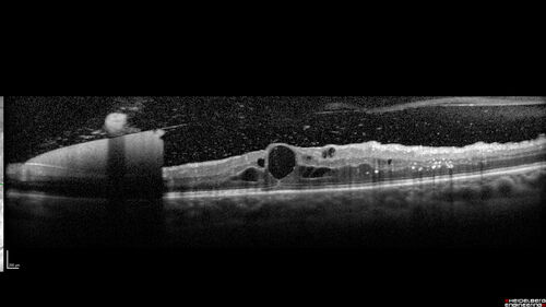 Proliferative Diabetic Retinopathy and vitreous hemorrhage left eye
44 year old man with type II diabetes for 14 years and no eye examinations in the last 5 years.  VA 20/40 right eye and 20/60 left eye.  Vision loss has been for about a week in the left eye.
