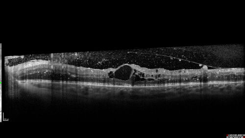 Proliferative Diabetic Retinopathy and vitreous hemorrhage left eye
44 year old man with type II diabetes for 14 years and no eye examinations in the last 5 years.  VA 20/40 right eye and 20/60 left eye.  Vision loss has been for about a week in the left eye.
