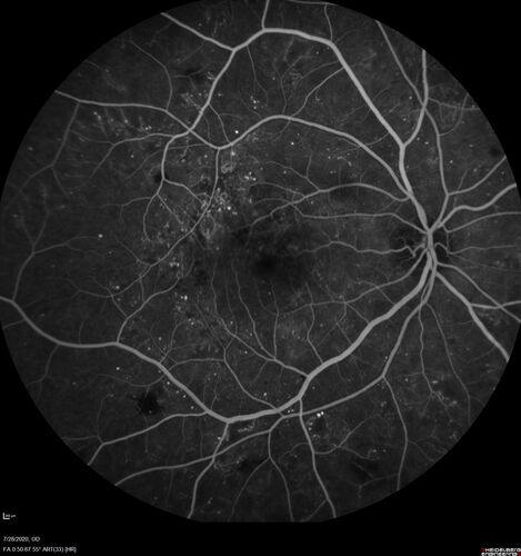 Proliferative Diabetic Retinopathy and vitreous hemorrhage left eye
44 year old man with type II diabetes for 14 years and no eye examinations in the last 5 years.  VA 20/40 right eye and 20/60 left eye.  Vision loss has been for about a week in the left eye.
