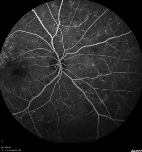 Proliferative Diabetic Retinopathy and vitreous hemorrhage left eye
44 year old man with type II diabetes for 14 years and no eye examinations in the last 5 years.  VA 20/40 right eye and 20/60 left eye.  Vision loss has been for about a week in the left eye.
