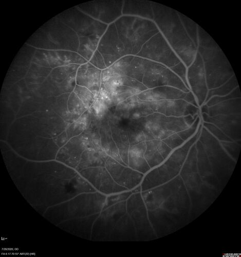 Proliferative Diabetic Retinopathy and vitreous hemorrhage left eye
44 year old man with type II diabetes for 14 years and no eye examinations in the last 5 years.  VA 20/40 right eye and 20/60 left eye.  Vision loss has been for about a week in the left eye.
