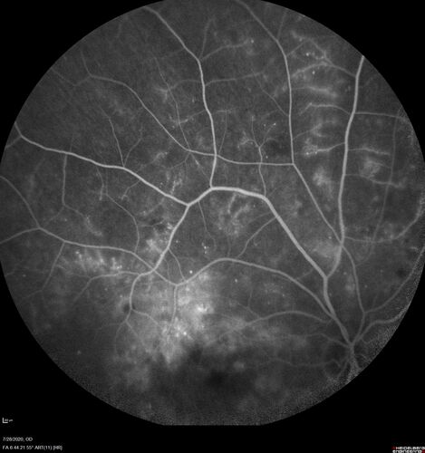Proliferative Diabetic Retinopathy and vitreous hemorrhage left eye
44 year old man with type II diabetes for 14 years and no eye examinations in the last 5 years.  VA 20/40 right eye and 20/60 left eye.  Vision loss has been for about a week in the left eye.

