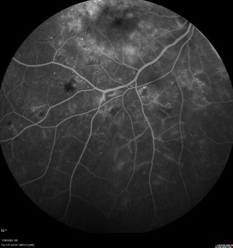 Proliferative Diabetic Retinopathy and vitreous hemorrhage left eye
44 year old man with type II diabetes for 14 years and no eye examinations in the last 5 years.  VA 20/40 right eye and 20/60 left eye.  Vision loss has been for about a week in the left eye.
