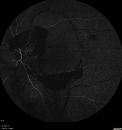 Proliferative Diabetic Retinopathy and vitreous hemorrhage left eye
44 year old man with type II diabetes for 14 years and no eye examinations in the last 5 years.  VA 20/40 right eye and 20/60 left eye.  Vision loss has been for about a week in the left eye.
