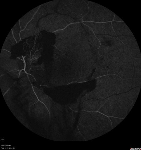 Proliferative Diabetic Retinopathy and vitreous hemorrhage left eye
44 year old man with type II diabetes for 14 years and no eye examinations in the last 5 years.  VA 20/40 right eye and 20/60 left eye.  Vision loss has been for about a week in the left eye.
