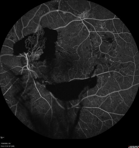 Proliferative Diabetic Retinopathy and vitreous hemorrhage left eye
44 year old man with type II diabetes for 14 years and no eye examinations in the last 5 years.  VA 20/40 right eye and 20/60 left eye.  Vision loss has been for about a week in the left eye.
