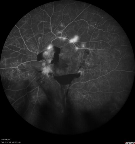 Proliferative Diabetic Retinopathy and vitreous hemorrhage left eye
44 year old man with type II diabetes for 14 years and no eye examinations in the last 5 years.  VA 20/40 right eye and 20/60 left eye.  Vision loss has been for about a week in the left eye.
