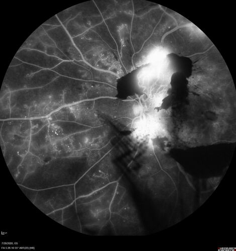 Proliferative Diabetic Retinopathy and vitreous hemorrhage left eye
44 year old man with type II diabetes for 14 years and no eye examinations in the last 5 years.  VA 20/40 right eye and 20/60 left eye.  Vision loss has been for about a week in the left eye.
