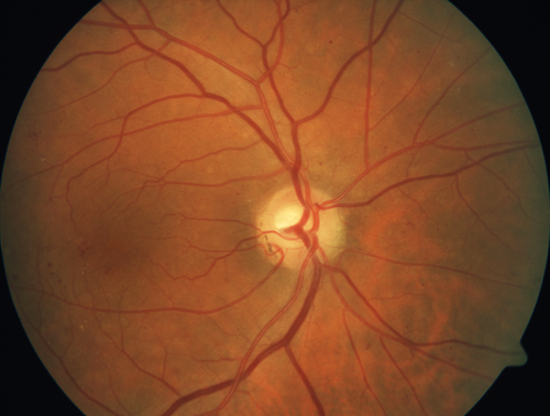 Mild Proliferative Diabetic Retinopathy
Right eye has NVE and left eye has NVD and NVE.  VA 20/25 OU.
