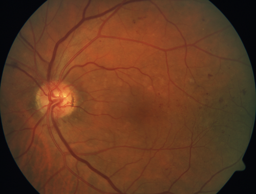 Mild Proliferative Diabetic Retinopathy
Right eye has NVE and left eye has NVD and NVE.  VA 20/25 OU.
