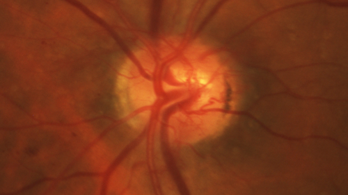 Mild Proliferative Diabetic Retinopathy
Right eye has NVE and left eye has NVD and NVE.  VA 20/25 OU.
