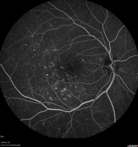 Mild Proliferative Diabetic Retinopathy
Right eye has NVE and left eye has NVD and NVE.  VA 20/25 OU.
