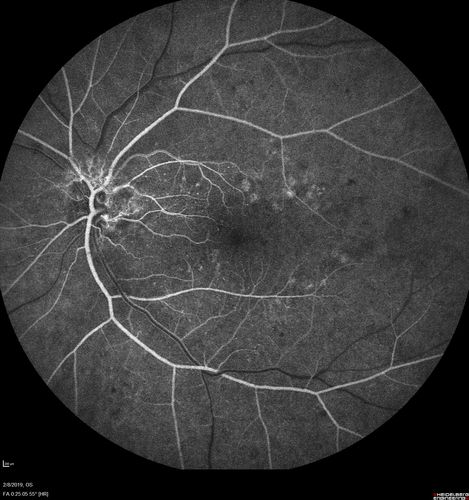 Mild Proliferative Diabetic Retinopathy
Right eye has NVE and left eye has NVD and NVE.  VA 20/25 OU.
