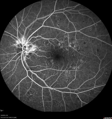 Mild Proliferative Diabetic Retinopathy
Right eye has NVE and left eye has NVD and NVE.  VA 20/25 OU.
