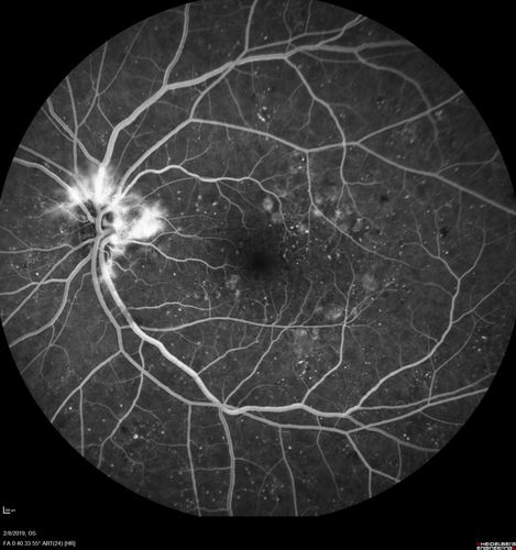 Mild Proliferative Diabetic Retinopathy
Right eye has NVE and left eye has NVD and NVE.  VA 20/25 OU.
