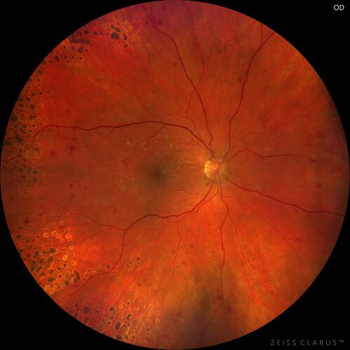 PDR and Vitreous Hemorrhage with inadequate PRP (nonperfusion)
36 year old with recent vision loss.  Diabetes since age 8.  Had light PRP done previously.  VA 20/25, 20/80
