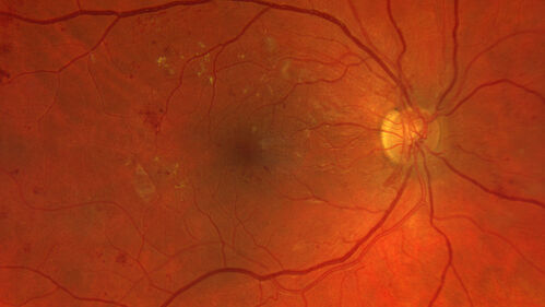 PDR and Vitreous Hemorrhage with inadequate PRP (nonperfusion)
36 year old with recent vision loss.  Diabetes since age 8.  Had light PRP done previously.  VA 20/25, 20/80
