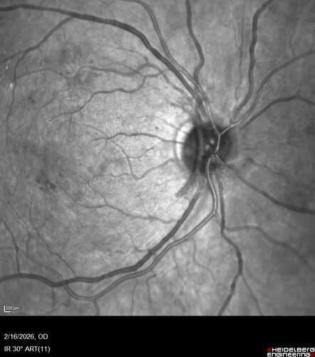 PDR and Vitreous Hemorrhage with inadequate PRP (nonperfusion)
36 year old with recent vision loss.  Diabetes since age 8.  Had light PRP done previously.  VA 20/25, 20/80
