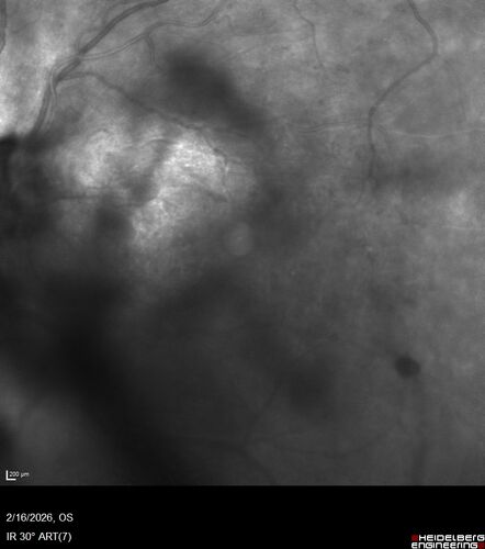 PDR and Vitreous Hemorrhage with inadequate PRP (nonperfusion)
36 year old with recent vision loss.  Diabetes since age 8.  Had light PRP done previously.  VA 20/25, 20/80
