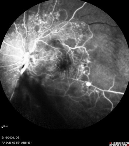 PDR and Vitreous Hemorrhage with inadequate PRP (nonperfusion)
36 year old with recent vision loss.  Diabetes since age 8.  Had light PRP done previously.  VA 20/25, 20/80

