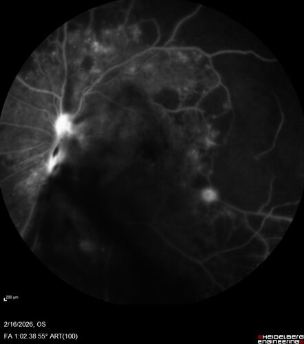PDR and Vitreous Hemorrhage with inadequate PRP (nonperfusion)
36 year old with recent vision loss.  Diabetes since age 8.  Had light PRP done previously.  VA 20/25, 20/80
