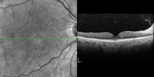 No significant macular edema
