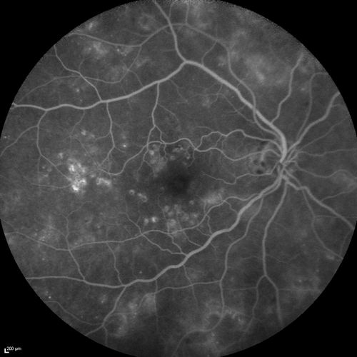 BDR right eye - previous laser
