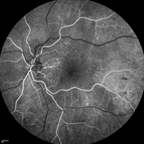 FA showing NVE, NVD, non- perfusion left eye inferonasally with neovascularization at the margin of the non-perfusion
