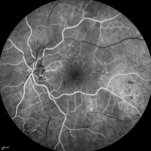 FA showing NVE, NVD, non- perfusion left eye inferonasally with neovascularization at the margin of the non-perfusion
