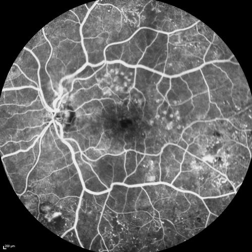 FA showing NVE, NVD, non- perfusion left eye inferonasally with neovascularization at the margin of the non-perfusion
